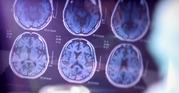 المرحلة الثانية من مرض ألزهايمر